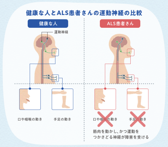 健康な人とALS患者さんの運動神経の比較